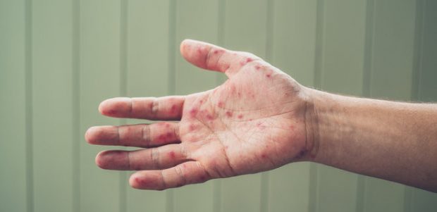 В Киеве зафиксировали первую смерть от кори