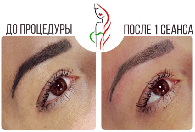 Удаление татуажа бровей в Киеве