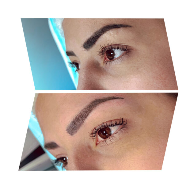 Удаление татуажа бровей в Киеве