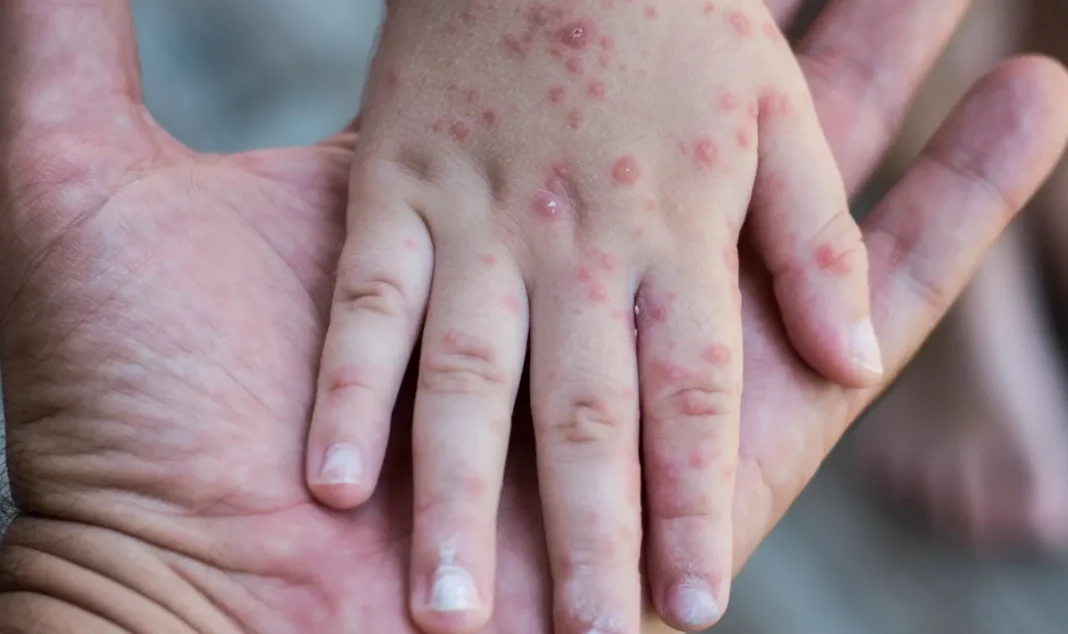 Спалах вірусу Коксакі на Київщині: 13 дітей захворіло, що потрібно знати